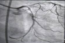 Angioplasty