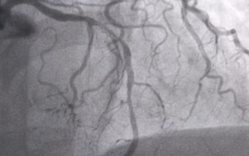 Angioplasty in only 20 minutes by MORPH TAPERING
