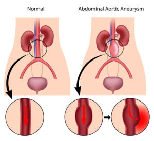 Abdominal-Aortic-Aneurysm