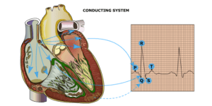 Arrhythmia