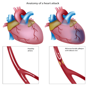 Myocardial Infarction