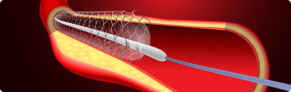 Sheathless Angioplasty