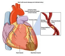 Acute Coronory Syndrome Acute Coronory Syndrome