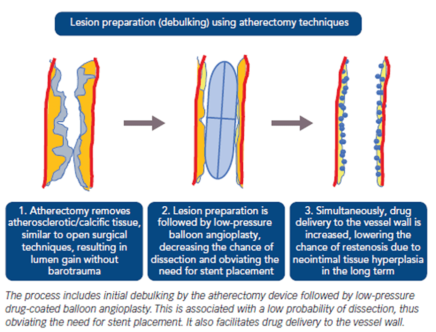 Orbital Atherectomy