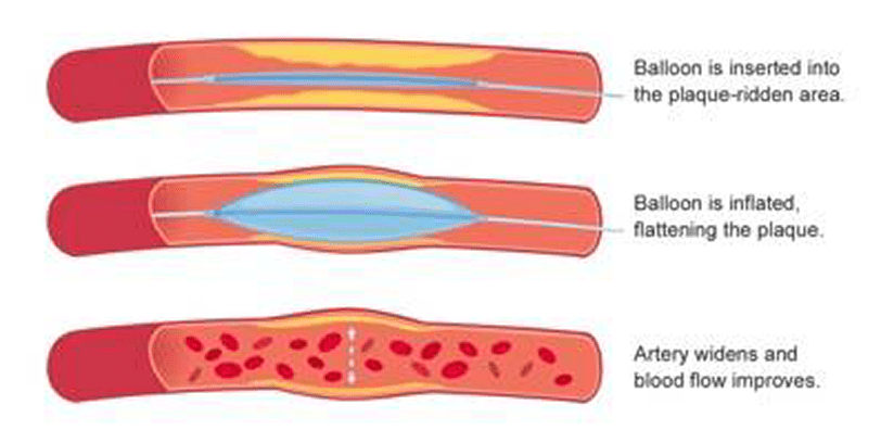 Balloon Angioplasty Balloon Angioplasty