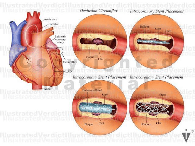 Peripheral Artery Disease Intervention