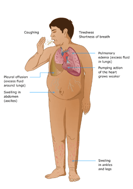 Heart Failure Heart Failure