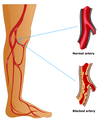 Peripheral Arterial Disease