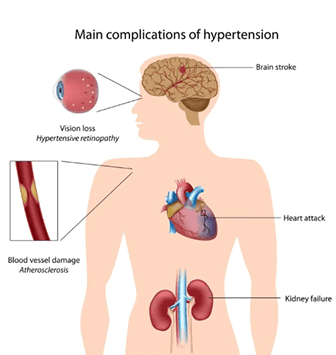 Hypertension Hypertension